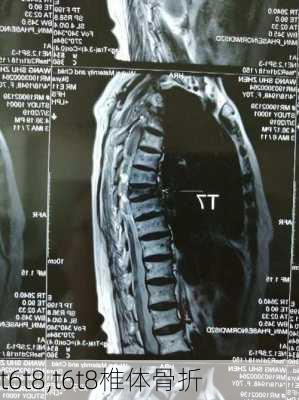 t6t8,t6t8椎体骨折